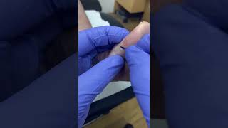 Watch as an Aussie podiatrist tackles tough toe callus Unveiling healthy skin beneath [upl. by Aniaj]