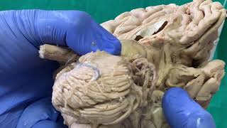 Dissection  Sulci amp Gyri on inferior surface of brain [upl. by Terrijo]