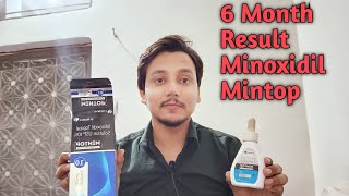 100 Results 6 Month Beard results Minoxidil Dr Reddy Mintop 10 [upl. by Ailina]