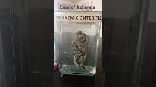 Ischemic Entritis case of ischemia of intestine likesharesubscribe MedicoMishtii [upl. by Ainaled902]