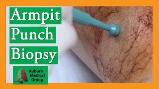 Armpit Sebaceous Cyst Punch Biopsy Removal  Auburn Medical Group [upl. by Notlew96]