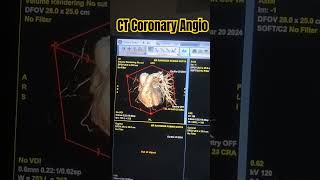 CT Coronary Angiography  Post processing medicos1k86 radiology ct heart trending cardiacct [upl. by Charmain]