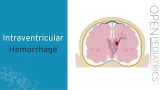 Intraventricular Hemorrhage by A Hansen  OPENPediatrics [upl. by Ivel]