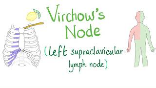 Virchows Node Left Supraclavicular Lymph Node  Cancer  Oncology [upl. by Eselahc316]