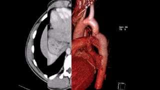 КТ грудной клетки коарктация аорты [upl. by Mccartan624]