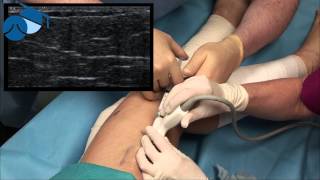 Foam sclerotherapy treatment of feeder veins varicose veins [upl. by Narmak]