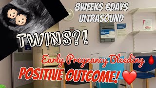 Bleeding In Early Pregnancy Positive Outcome 86 weeks ultrasound IS IT TWINS 🤭 [upl. by Raine396]