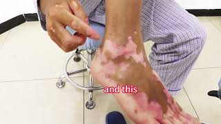 MCDR Treatment for Vitiligo 2024 [upl. by Giuditta]