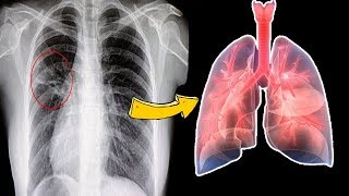 How to Cure Pneumonia Without Antibiotics  8 Home Remedies to Treat Pneumonia at Home [upl. by Medin]