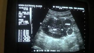 ultrasound  COMPLEX MASS RT ADNEXA [upl. by Enialahs]