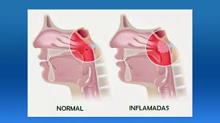 ¿Cuáles son las causas de las adenoides [upl. by Searby]