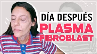 PLASMA PEN FIBROBLAST día 1 plasma pen antes y después plasmafibroblast carolinatv CarolinaSKB [upl. by Larkin765]