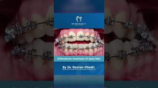 Orthodontic correction of open bite and cross bite by our Orthodontist Dr Rezvan [upl. by Reibaj]