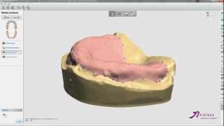 Full DentureUpper Model Analysis [upl. by Avra]