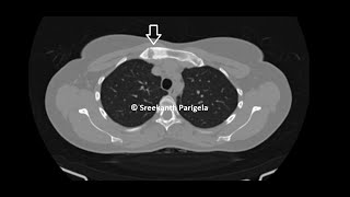 SAPHO syndrome  CT Chest [upl. by Ainej]