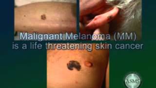 Skin cancer types basal cell squamous cell carcinoma malignant melanoma causes prevention Miami [upl. by Bernhard]