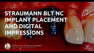 Straumann BLT Implant Placement and Digital Impressions [upl. by Ariamoy]