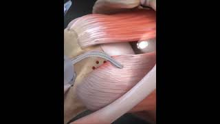 Subscapularis tendon tear  animationshorts shortsfeed youtubeshorts viralshorts [upl. by Annairam]