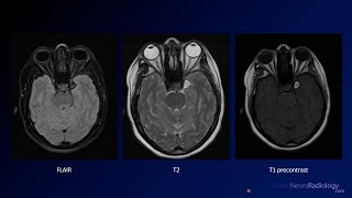 Neuroradiology Board Review  Brain Tumors  Case 8 [upl. by Abernathy166]