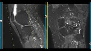 Ill defined bone lesion in tibia [upl. by Hovey435]