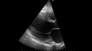 parasternal long axis echo of a patient with dilated cardiomyopathy [upl. by Sigismundo]