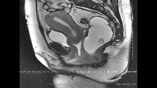 Laparoscopic – Pelvic Organ Prolapse suspension L POPs 2 [upl. by Secnarfyram]