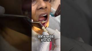 Dental bridge  live fixing dental bridge shorts [upl. by Malha]