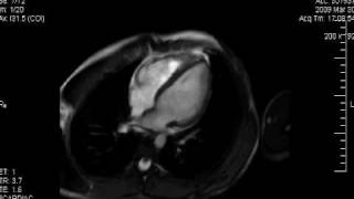 Cardiología HU  Resonancia Magnética Cardiaca Normal [upl. by Stoneham]