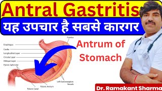 Antral Gastritis Causes Symptoms and Effective Treatments drramakantsharma7 [upl. by Ahsytal569]