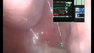 Drug Induced Sleep Endoscopy large adenoids and tonsils in 51 year old [upl. by Eitten830]