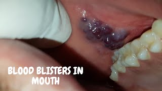 Blood blisters in mouth Angina bullosa hemorrhagicaमुँह के छाले  कारण [upl. by Bowie]