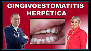 GINGIVOESTOMATITIS HERPÉTICA AGUDA  Virus Herpes Simple VHS1 [upl. by Anecuza]