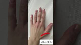 Vitiligo on Hands  Best treatment for vitiligo  Vitiligo Specialist [upl. by River]