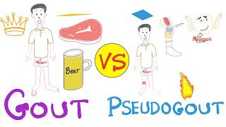 Gout vs Pseudogout  MSU vs CPPD disease  Rheumatology Series [upl. by Hoang337]