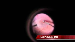 ILM Graft Autoinjerto de MLI para Agujero Macular Persistente [upl. by Yrakcaz425]