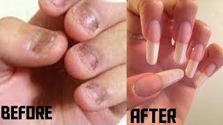 How to grow long Nails really Very Fast in 7 days [upl. by Elnukeda]