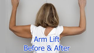 Arm Lift 14 Weeks Post Op FAQs  Brachioplasty Surgery Journey Part 3 [upl. by Aneelak54]