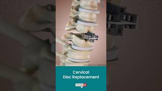 Cervical Disc Replacement Surgery ↪ 3D Medical Animation Shorts DiscReplacement Surgery [upl. by Aken]