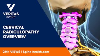 Cervical Radiculopathy Overview [upl. by Eloise]