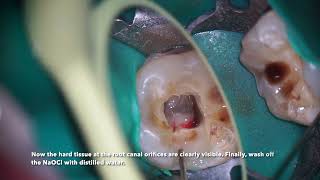 Pulpotomy for cracked teeth with severe bleeding [upl. by Ury]