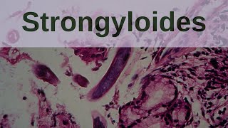 Strongyloides and Strongyloidiasis  Pathology mini tutorials [upl. by Rebmac809]