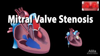 Mitral Valve Stenosis Animation [upl. by Ardeha110]