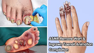 ASMR Remove Wart amp Ingrown Toenail Animation Compilation  Deep Cleaning Animation [upl. by Nemrak606]