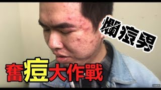 爛痘男 奮痘大作戰  擠粉刺篇膽小者誤入「牛舌來生活第29集」 [upl. by Lefkowitz]