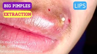 Mụn bọc môi toDermatologistpimples whitehead blackheadanti acnesevere pustule removal [upl. by Ansilme119]