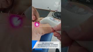 PO FRATURA proximal de úmero  Laserterapia e Dry Needling [upl. by Adlar]