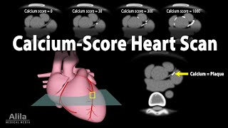 Calcium Score Heart Scan Animation [upl. by Toni]