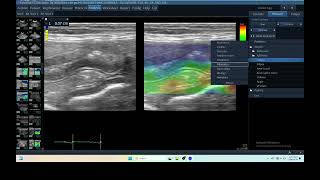 IQ 284 PANCREATIC ELASTOGRAPHY GI BLEEDING ULTRASOUND ECHOPAC ANALYSIS [upl. by Meyeroff]