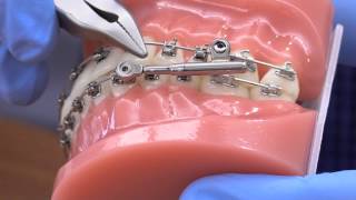 American Orthodontics PowerScope Activation [upl. by Refanej358]