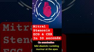 mitralvalve stenosis ecg xray shortnessofbreath cardiology mbbsstudent doctor [upl. by Eimarrej]